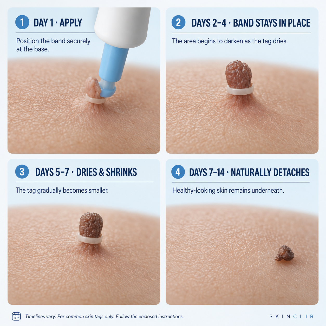 SKINCLIR | Skin Tag Removal Made Simple